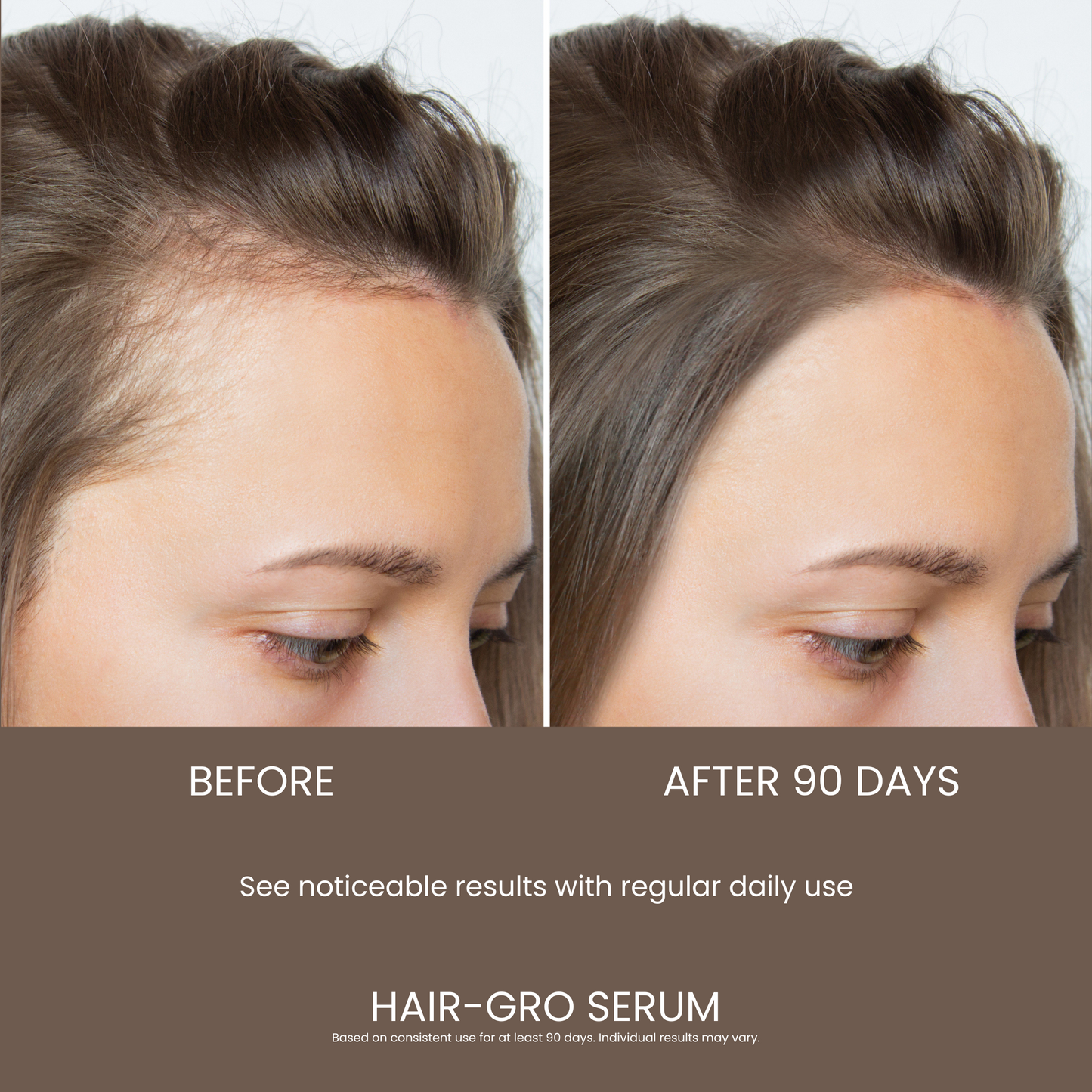 Before and after comparison of hair growth with HAIR-GRO SERUM, showing results after 90 days.